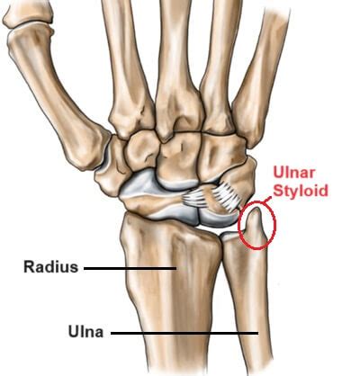 Ulnar Styloid Process Fracture