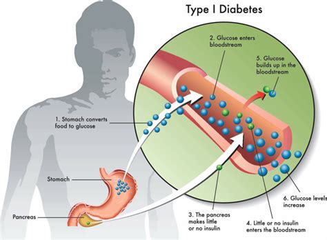 Understanding Diabetes Canyon View Medical