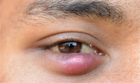 Understanding Styes Causes Symptoms And Treatments Auckland Eye