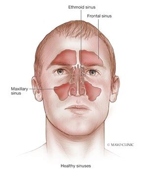 Unlocking The Mystery Of Your Sinuses Mayo Clinic Health System Unlocking The Mystery Of Your Sinuses Mayo Clinic Health System