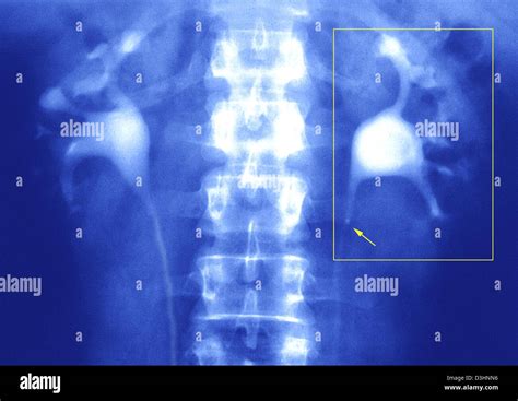 Ureteral Lithiasis X Ray Stock Photo Alamy