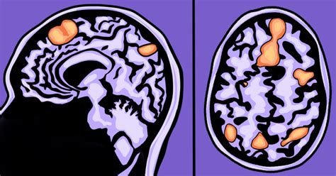 Ut Researchers Studying Intersection Of Trauma Genetics In Development