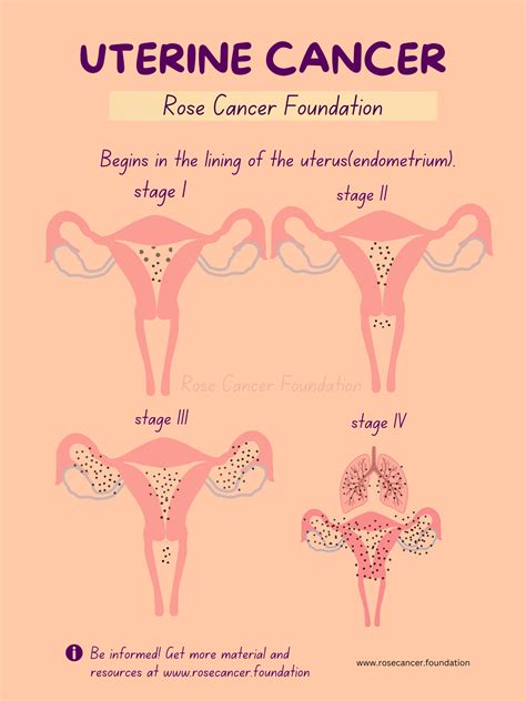 5 Ways Uterine Cancer Prognosis