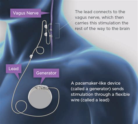 Vagus Nerve Stimulation For Seizures Epilepsy Foundation