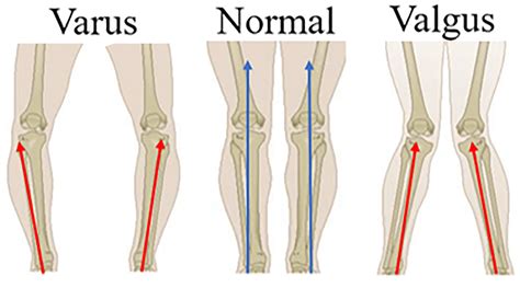 Varus Vs Valgus