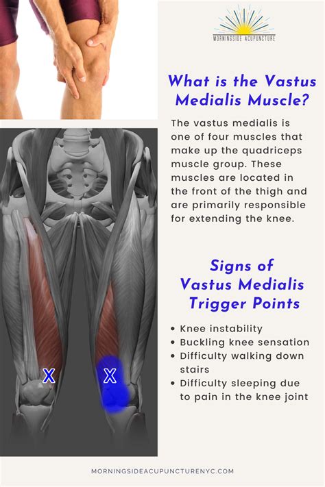 5 Ways to Ease Vastus Medialis Pain