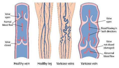 Venous Insufficiency New York Vein Treatment Center