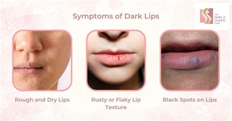 Vitamin B12 Deficiency Dark Spots On Lips At Pearl Murray Blog