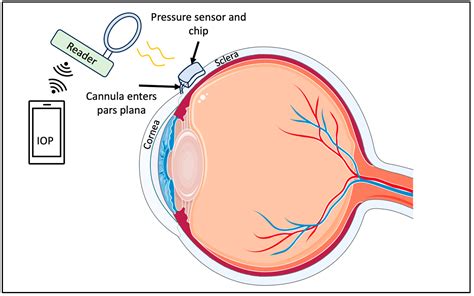 Wearable And Implantable Intraocular Pressure Biosensors Recent