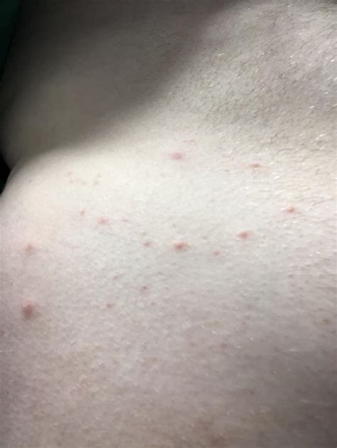 Weird Itchy Rash On Small Part Of Stomach Only R Dermatology Weird Itchy Rash On Small Part Of Stomach Only R Dermatology