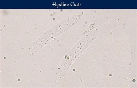What Are Hyaline Casts In Urine Know Here Credihealth
