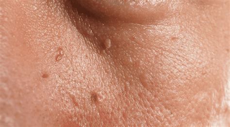 What Are Skin Tags Causes Of Skin Tags Schweiger Dermatology What Are Skin Tags Causes Of Skin Tags Schweiger Dermatology