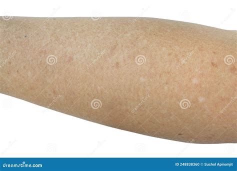 What Are Those White Spots On My Arms Idiopathic Gutt Vrogue Co