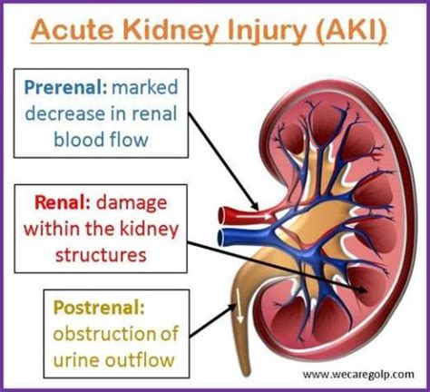 What Causes Acute Kidney Injury Aki What We Know About It