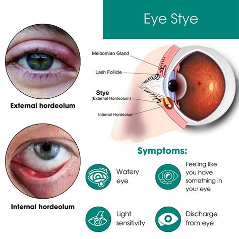 What Causes Styes And How To Avoid Them Valley Eyecare