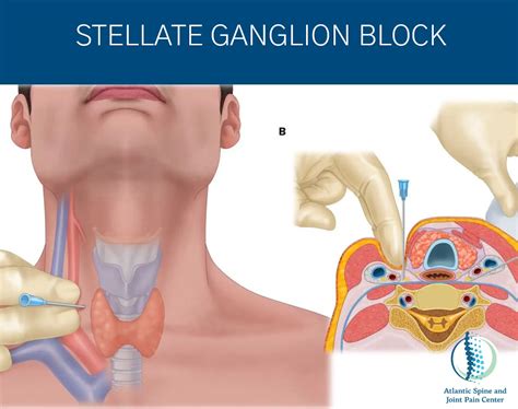 What Is A Stellate Ganglion Block Treasure Valley Pain Center