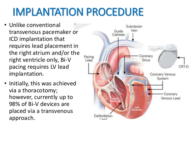 What Is Cardiac Resynchronization Therapy Crt And How Does What Is Cardiac Resynchronization Therapy Crt And How Does