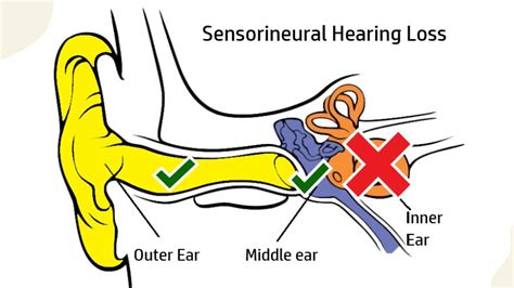 What Is Sensorineural Hearing Loss Causes Treatments Tests