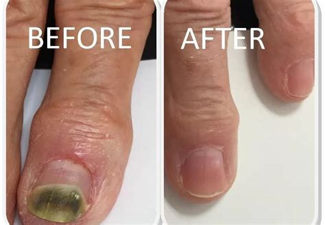 What Is The Most Effective Fungal Nail Treatment Sussex Foot Centre What Is The Most Effective Fungal Nail Treatment Sussex Foot Centre