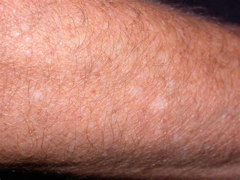 White Spots On Skin Pictures