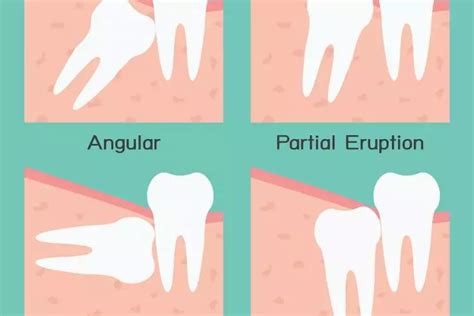 Why We Have Wisdom Teeth