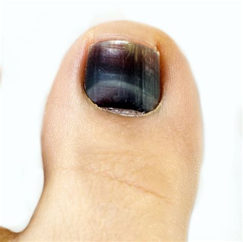 Why Is My Toenail Black
